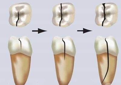 根管治疗过后还需要做牙套吗,根管治疗戴冠能用几年
