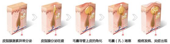 脸颊两侧长痘的原因是什么,脸颊两侧长痘的原因还痒