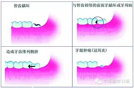 长智齿朋友圈说说心情,智齿的说说