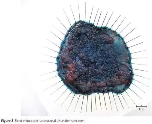 日本消化器内视镜学会结直肠ESD/EMR指南2015版（下）
