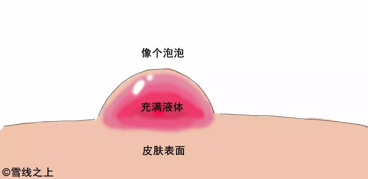 徒步走线时，如何防治水泡？