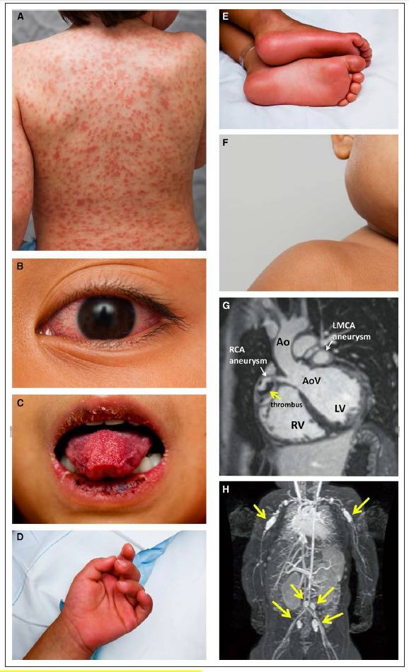 川崎病阅读,川崎病问诊要点