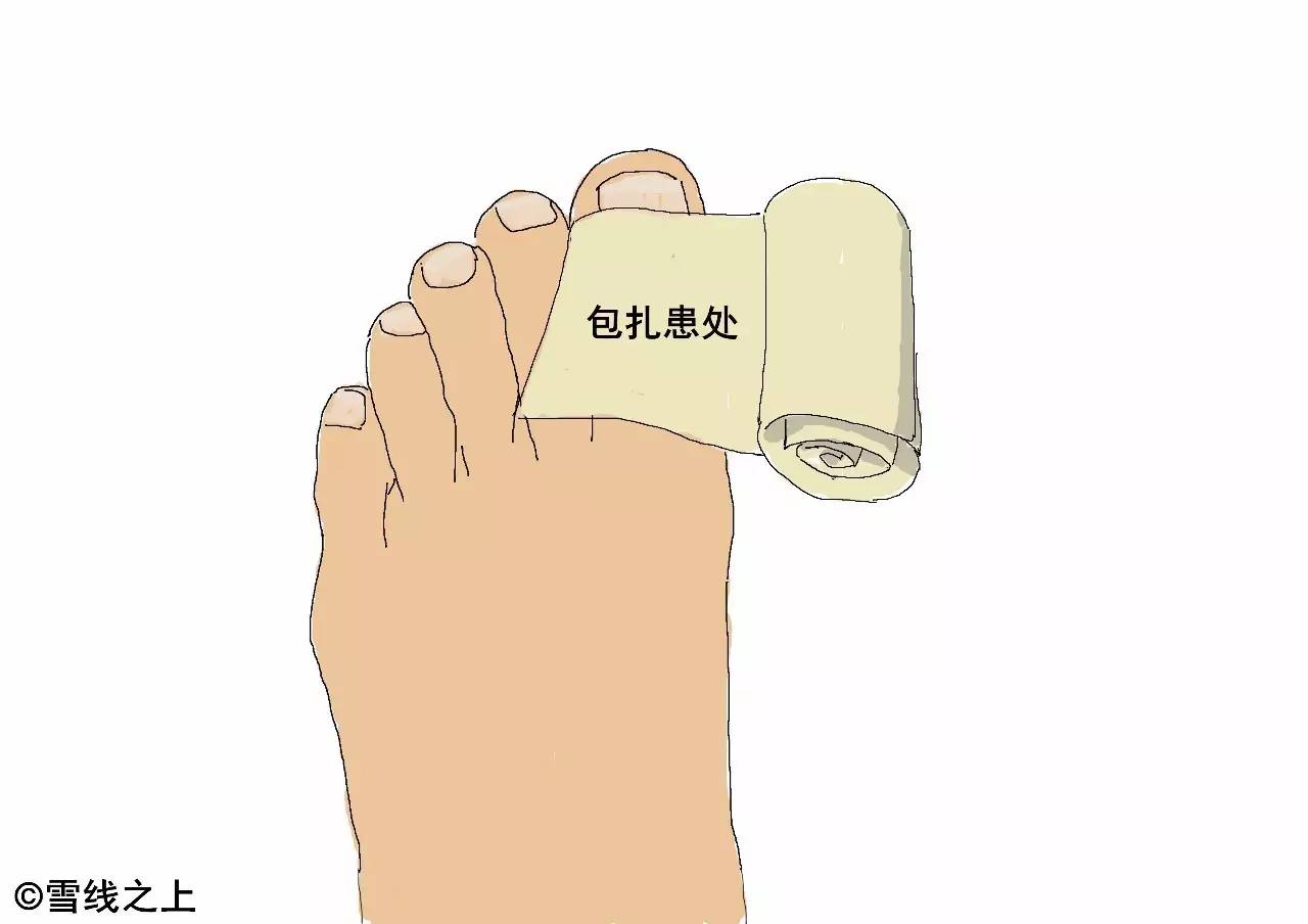 徒步走线时，如何防治水泡？