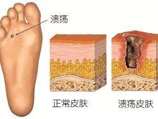 糖尿病足溃烂怎么治疗最有效,糖尿病足反复溃烂是什么原因