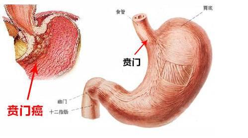 贲门癌打嗝严重是厉害了吗,贲门癌打嗝严重是什么情况