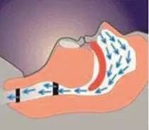 打鼾猝死几率高不高,打鼾致憋气停止怎么治疗