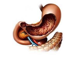 临床必读笔记胃癌 (胃癌康复笔记)