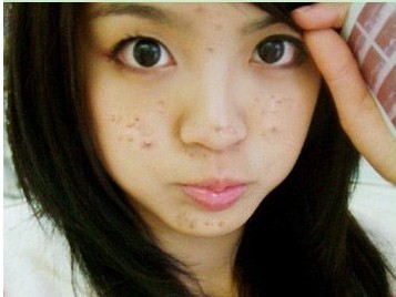 长了痘痘怎么办用什么产品,长了痘痘怎么办零成本