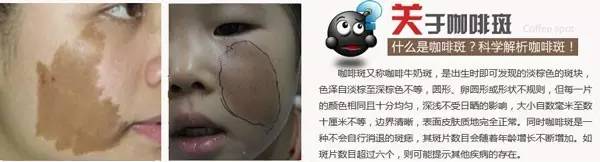 宝宝咖啡斑是晒的吗,宝宝咖啡斑长泡