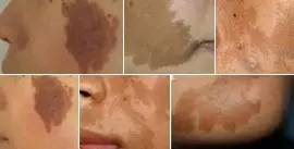 宝宝咖啡斑是晒的吗,宝宝咖啡斑长泡