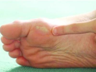 糖尿病足溃烂怎么治疗最有效,糖尿病足反复溃烂是什么原因