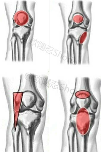 膝关节康复训练：7个动作康复髌腱炎，髂胫束症候群缓解膝盖疼痛