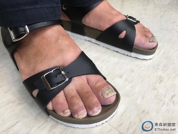 她脚趾甲卷成「吸管」状竟不是灰指甲在搞怪