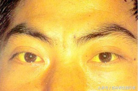 28岁小伙因为肝癌腹大如鼓，主任说太难治了！竟是这3点造成！