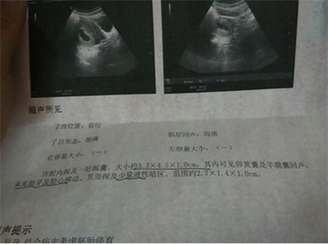 肚子里的孩子停胎了,孕30周停胎在肚子里