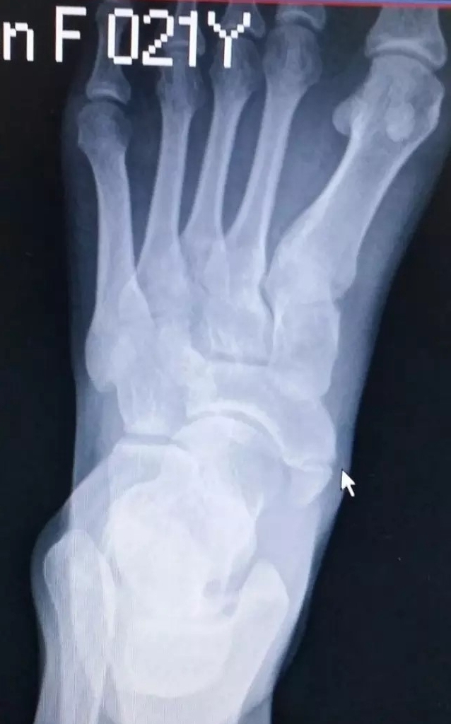 踝关节疼痛病因病机,踝关节伤病