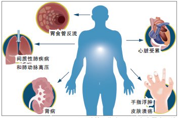 皮肤变硬的病,皮肤变硬就一定是硬皮病吗