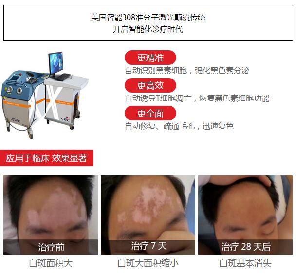 308治疗白癜风成功案例,308祛白斑效果怎么样