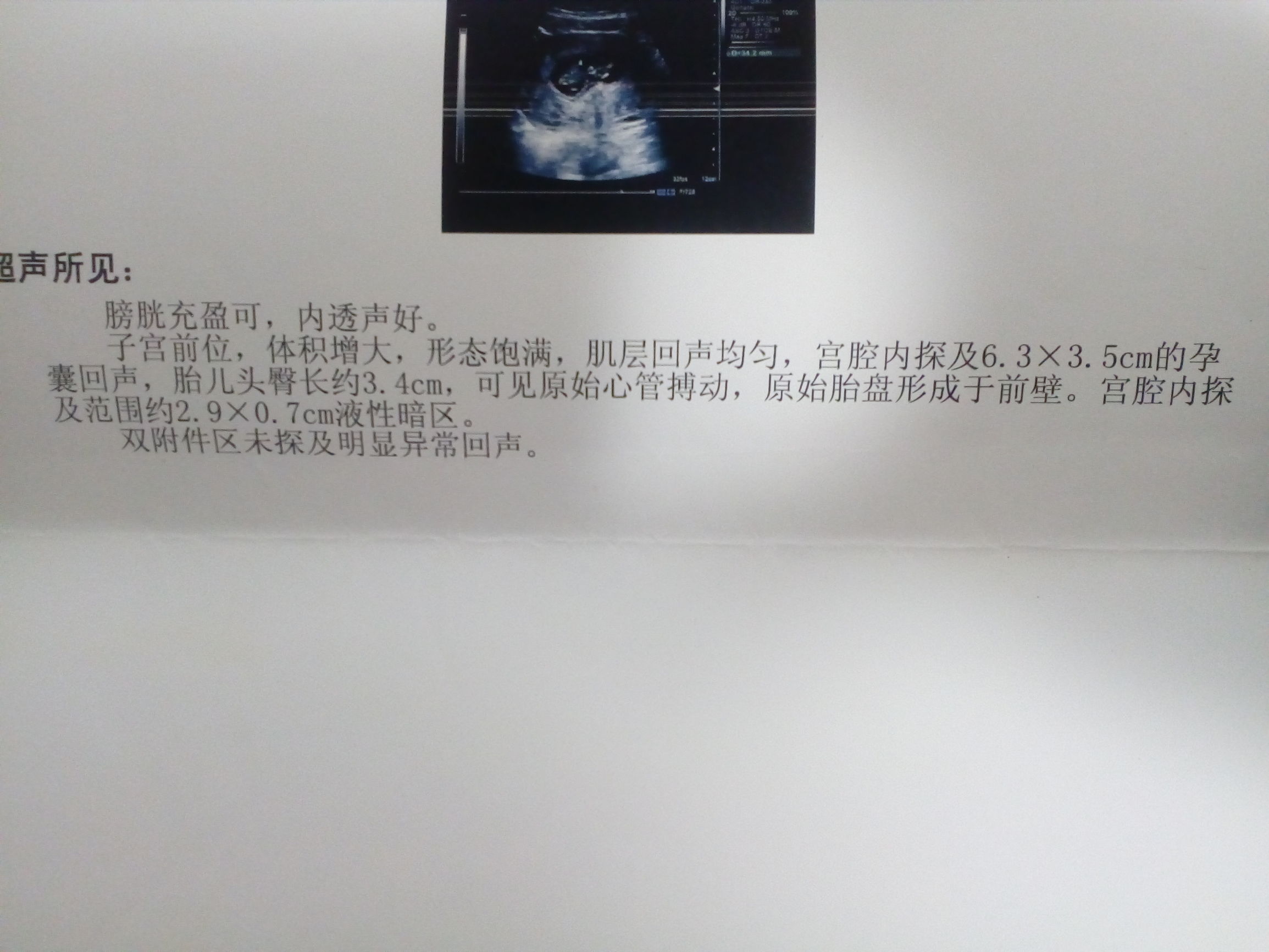 孕囊有积液先兆性流产保胎率高吗,孕中期宫腔积血会导致流产吗