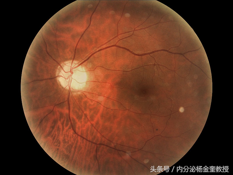 治疗糖尿病视网膜病变的药物,糖尿病视网膜病变的治疗新进展