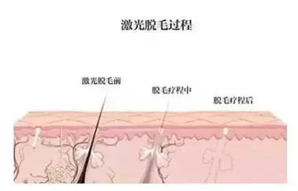 入夏前脱毛,最好用的脱毛小技巧是什么
