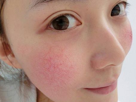 修复红血丝,眼睛痒有血丝还很红用什么眼药水