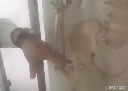 老年人腰部骨折手术好还是静养好,老年人骨折后有哪些后遗症