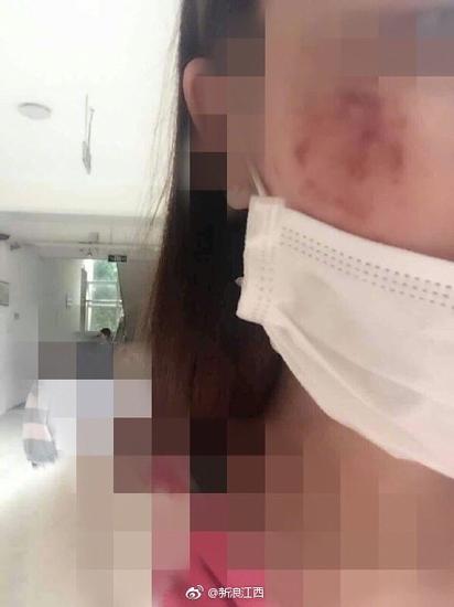 多名大学生惨遭毁容劣质化妆品致皮炎如何应对