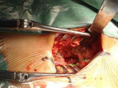 腰椎间盘突出345节怎样治疗才能好,腰椎间盘4-5节突出症恢复锻炼方法