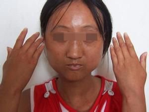 皮肤变硬的病,皮肤变硬就一定是硬皮病吗