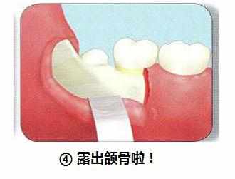 智齿横着长没露出来,智齿牙横着长怎么办