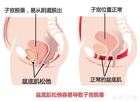 产后康复：漏尿、松弛？快做盆底锻炼