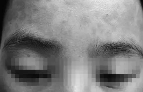 吃螃蟹谨慎食物中毒,吃螃蟹全身红肿