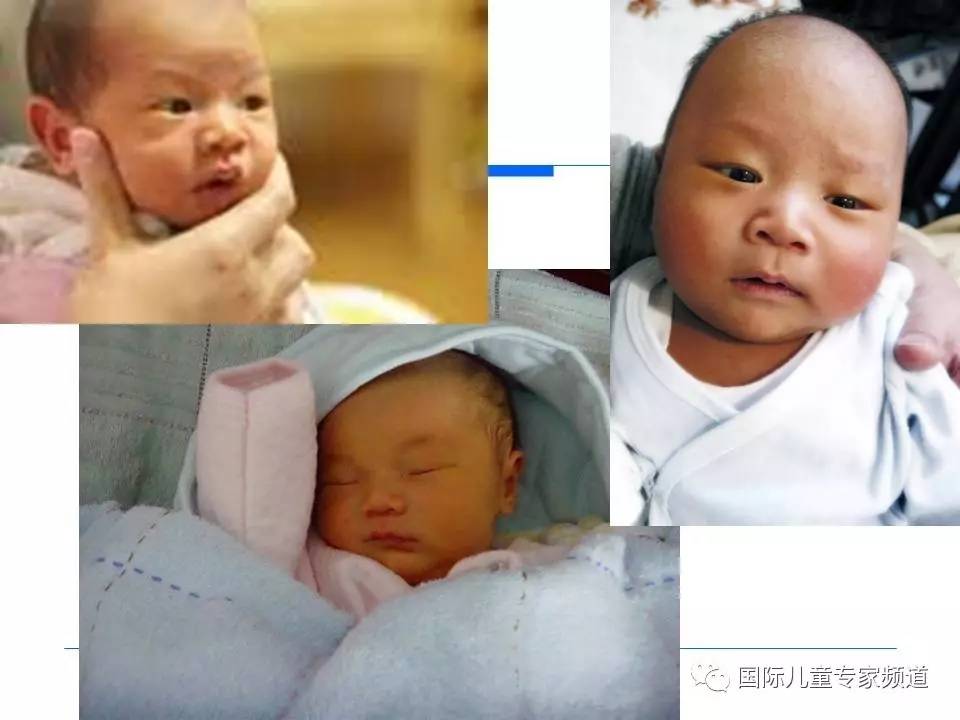 「PPT干货」国际儿童专家频道学术讲座.NO7——浙江大学医学院附属儿童医院消化科，陈洁主任主讲《婴儿胆汁淤积性肝病的诊治》