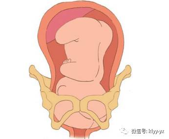 40周胎儿为何迟迟不入盆,胎儿足月迟迟不入盆