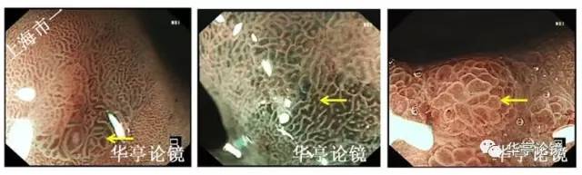 胃小灶癌变,胃体小凹型腺瘤