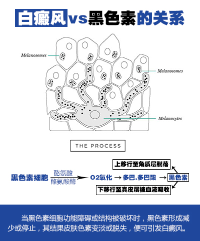 白癜风患者经常熬夜会加重病情吗,白癜风会因为怀孕病情加重吗