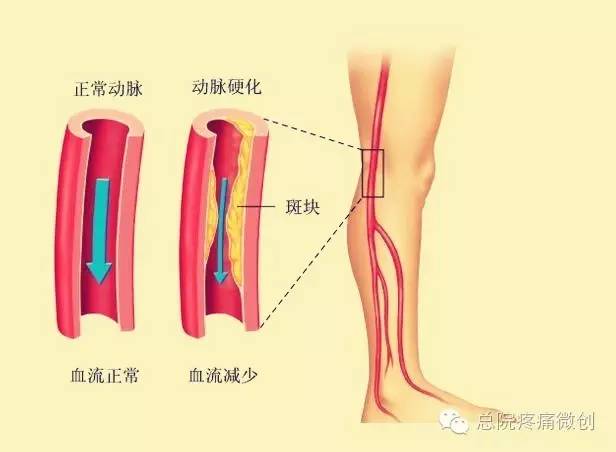 疼痛科治疗脚板痛的视频,疼痛科有哪些技术