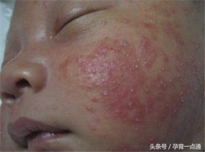 宝宝湿疹与室内湿度有关系吗,宝宝湿疹是太潮湿引起的吗