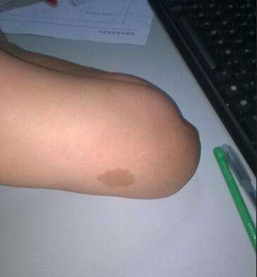 胳膊发冷是什么病？