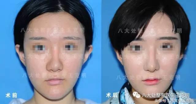 鼻整形后出现肿胀、假体外露歪斜、皮肤异样该怎么办？