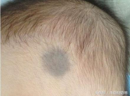 宝宝一出生脸上有一块褐色的胎记,婴儿有青色胎记是怎么回事