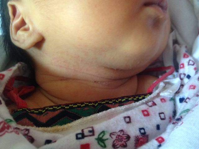 新生儿起红疹怎么回事,新生儿满月后满脸红疹