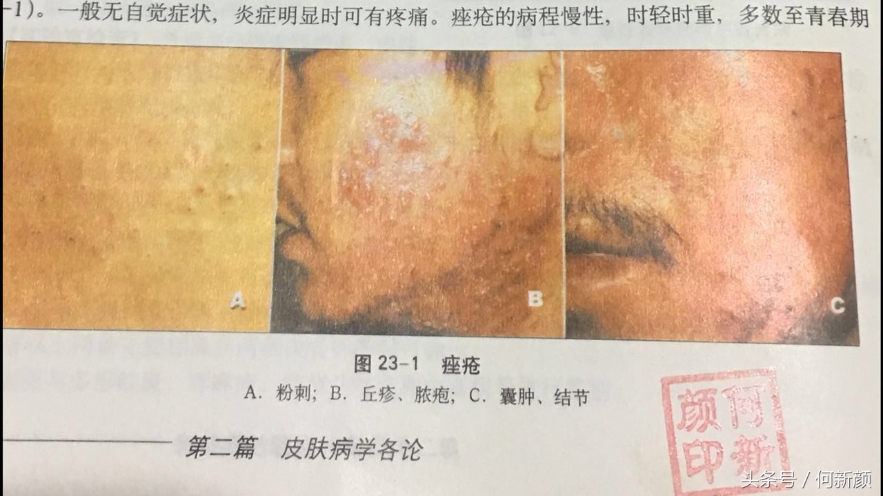 青春痘粉刺黑头怎么样清理效果好,长痘痘粉刺闭口怎么去