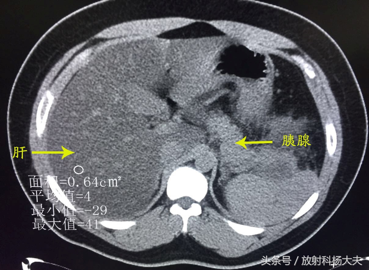 胰腺占位饭后肚子痛,吃火锅后肚子隐隐作痛