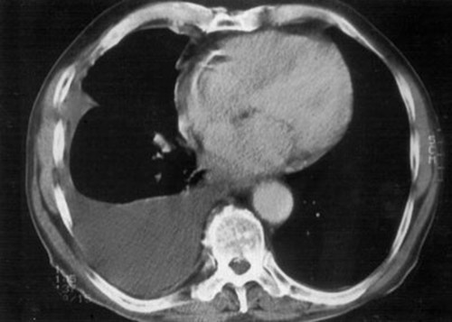 结核性胸膜炎胸痛中医治疗,胸痛12种图解