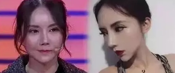 和阿姨的双眼皮做的太宽失败了