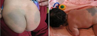 新生儿手上有青色胎记,新生儿易长的六种胎记