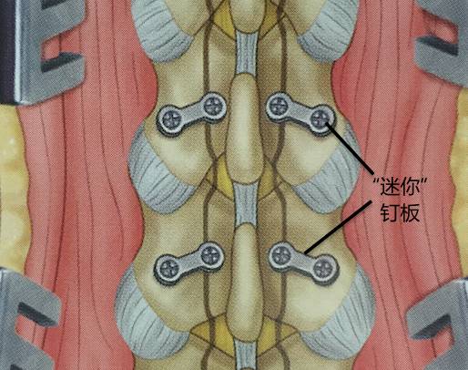 腰腿疼是椎管肿瘤吗,腰腿疼痛需要关注脊髓肿瘤吗