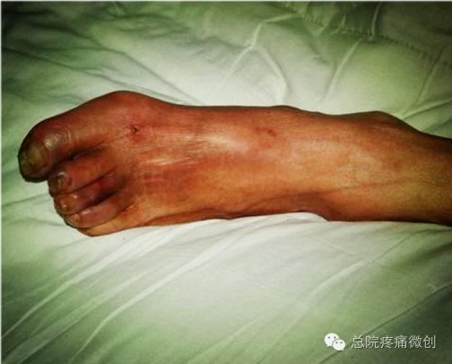 疼痛科治疗脚板痛的视频,疼痛科有哪些技术